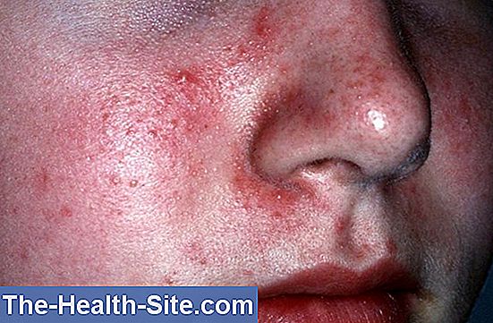 Dermatita seboreica sprancene