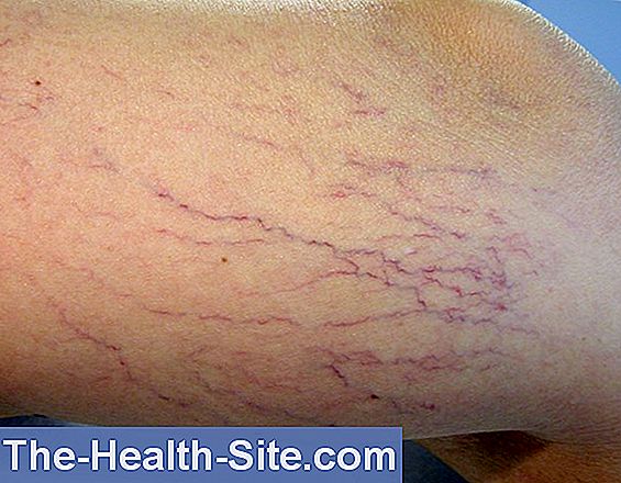Top 13 cauze care provoacă dezvoltarea venelor varicoase