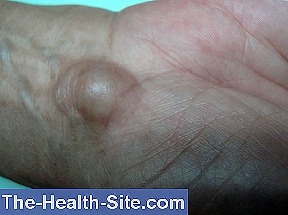 tratamentul ganglionului la încheietura mâinii