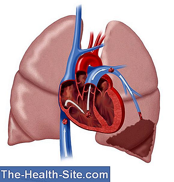 pierderea în greutate după embolismul pulmonar