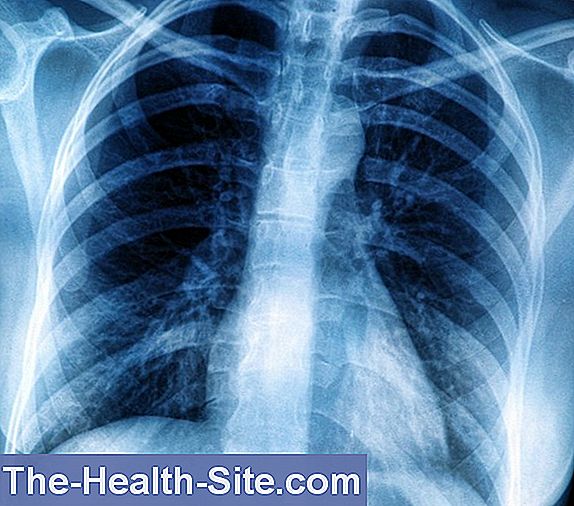 Fibroza pulmonară și Colagenozele pe radiografia toracică