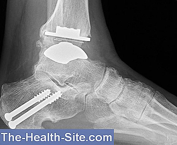 artroza pe articulațiile picioarelor deteriorarea ligamentelor gleznei și piciorului