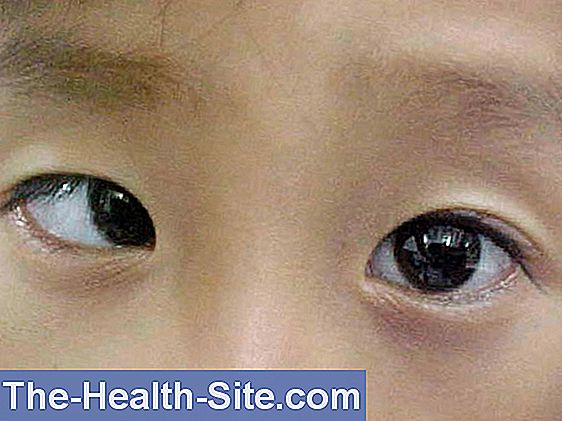 Strabismus 💊 Scientific Practical Medical Journal 2024