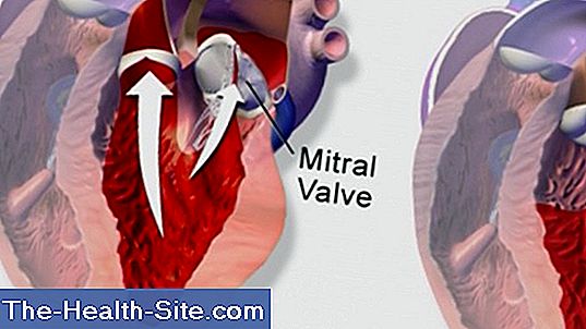 mitral-valve-insufficiency-heart-valve-failure-scientific-practical