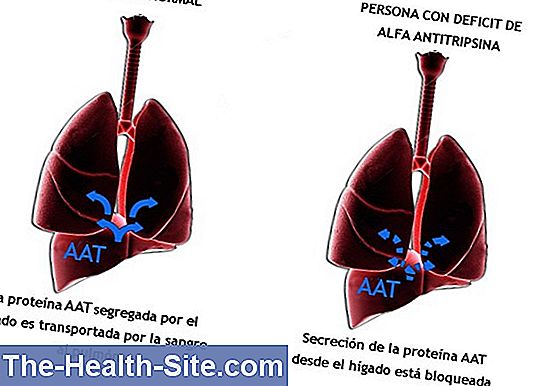 La deficiencia de alfa-1 antitripsina