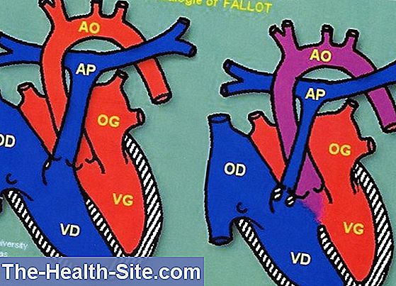 Tétralogie de fallot - malformations cardiaques congénitales