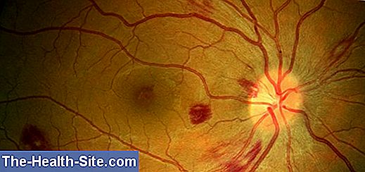 hipertenzijos retinopatija astigmatizmas su hipertenzija