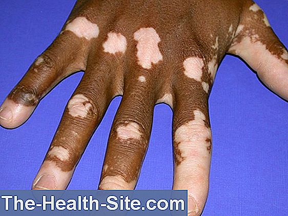 White spot disease (vitiligo)