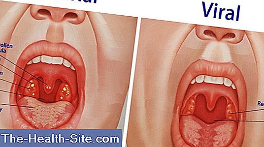 Angina (tonsillitis)
