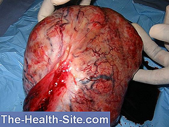 Fibroid tumorer