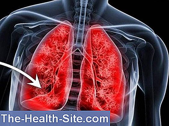 Morbus meulengracht síntomas de diabetes Morbus meulengracht síntomas de diabetes