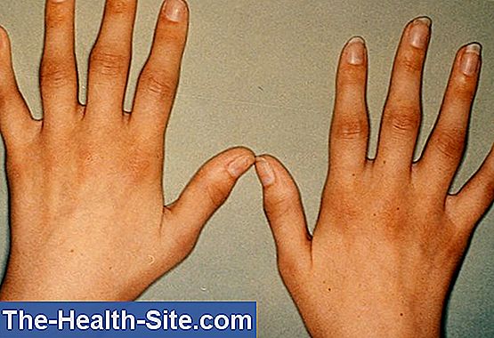 semne ale artritei degetelor