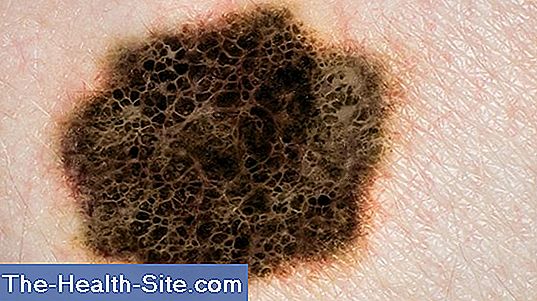 cancer de piele neagra retete de eliminare a parazitilor