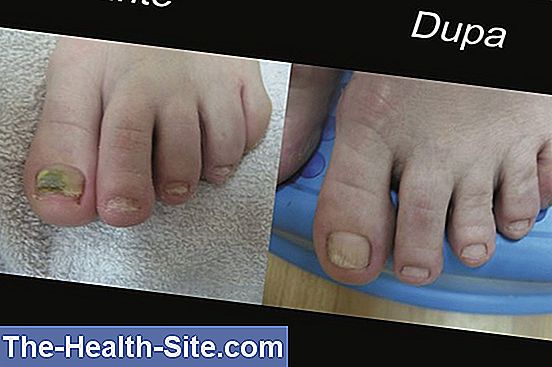 ce sunt sporii fungici de pe unghiile picioarelor