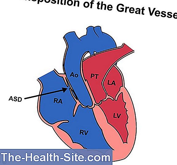 Transposition of the great arteries - tga - congenital heart defekter